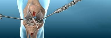 Keyhole (Arthroscopic) Surgery for Sports-Related Injuries and Ligament Reconstruction